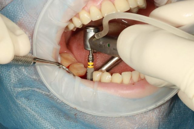 What Are The Different Types Of Dental Implants?