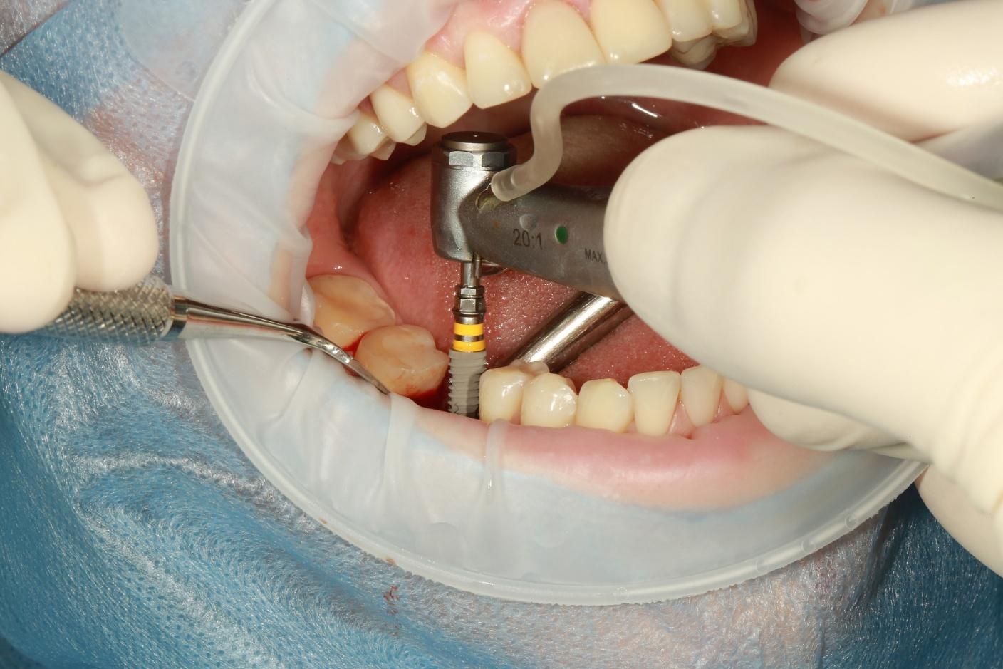 Types of Implants With Dental Care In Queens, New York