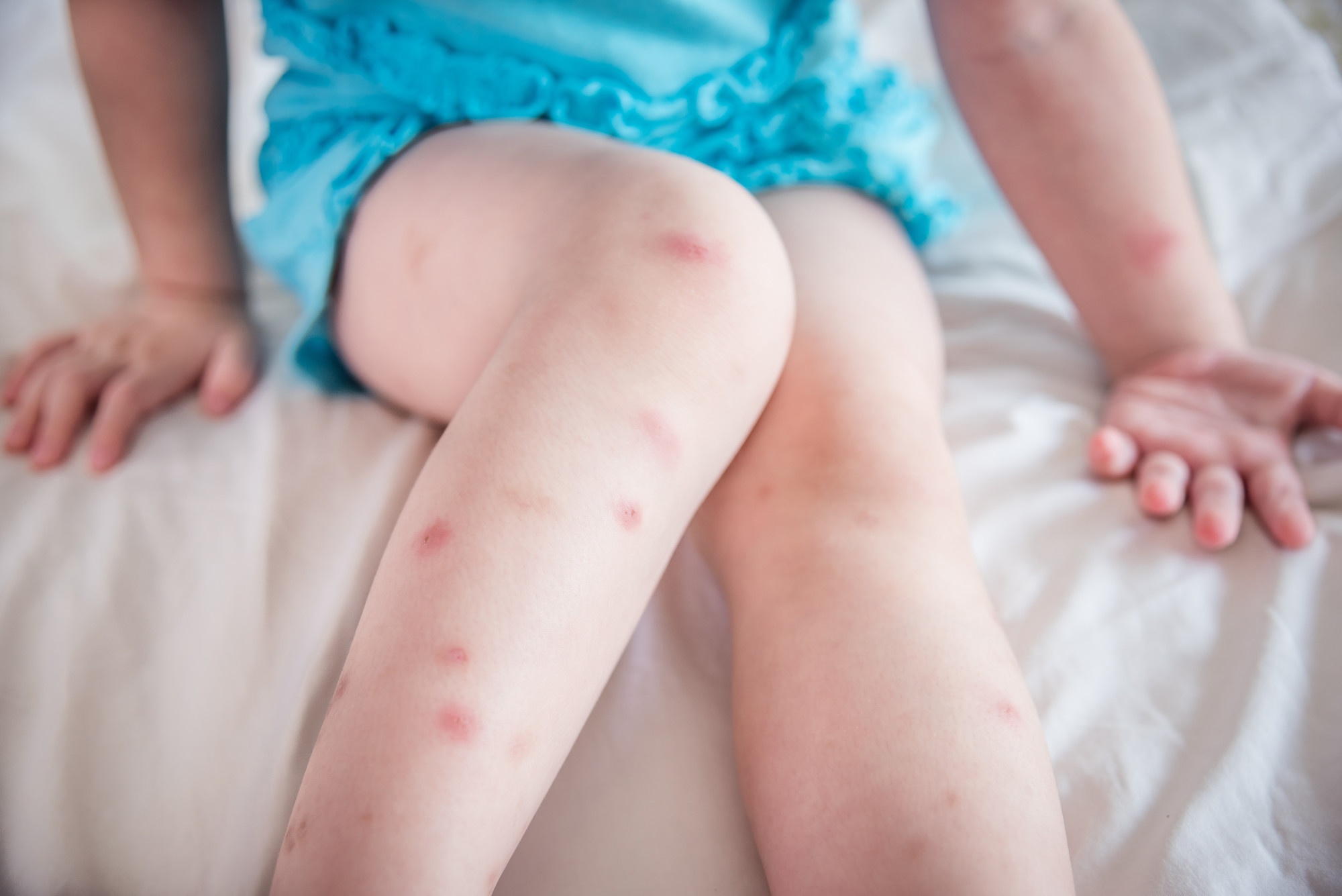Bed Bug Bites Vs. Scabies: Diagnosis and Treatment Tips