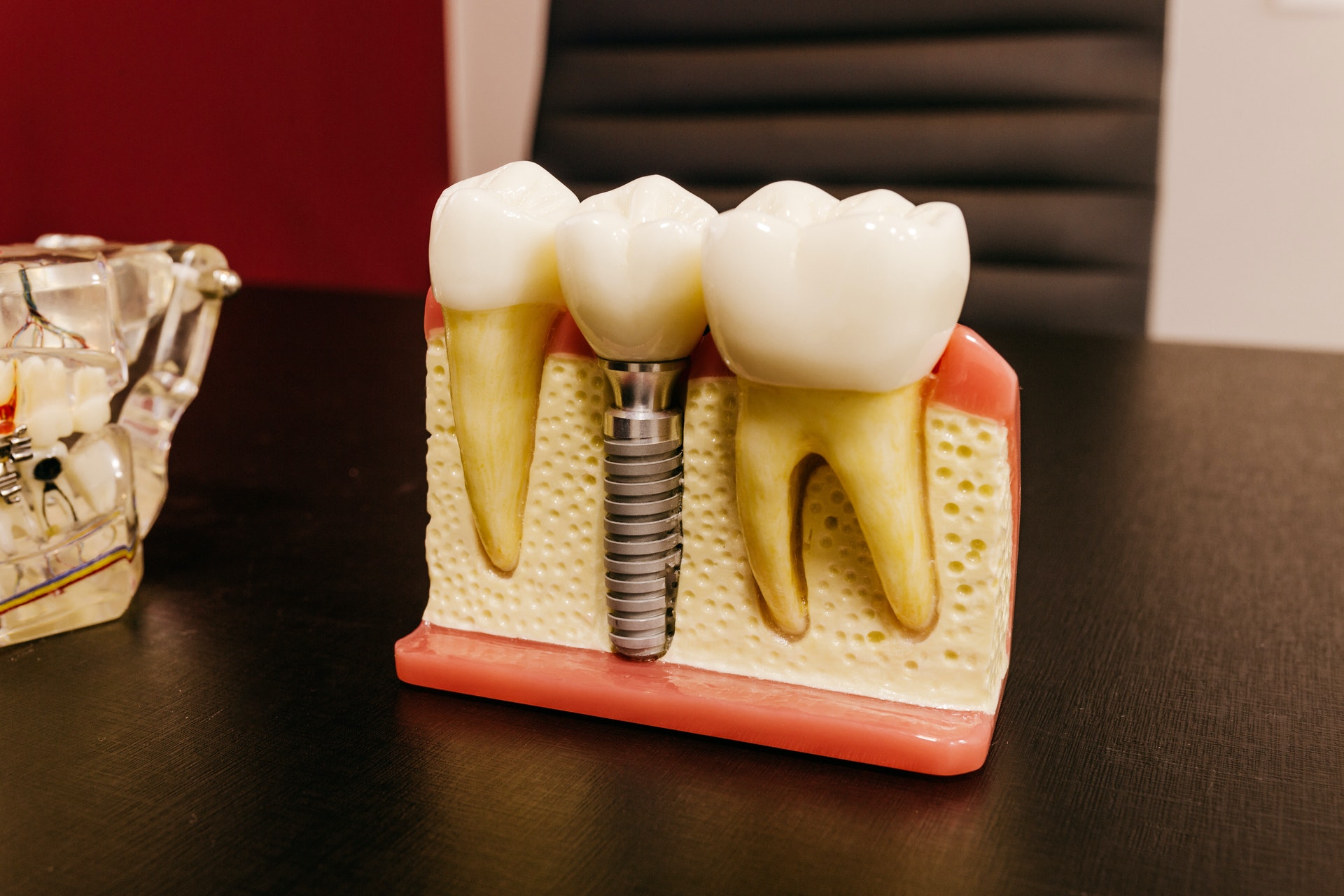 Transform Your Smile with Quality Implants