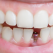 How to Prepare for a Tooth Implant Procedure