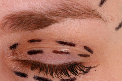 Getting an Eye Lift: Your Guide to Blepharoplasty!