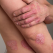 Home treatments for psoriasis; 5 effective remedies
