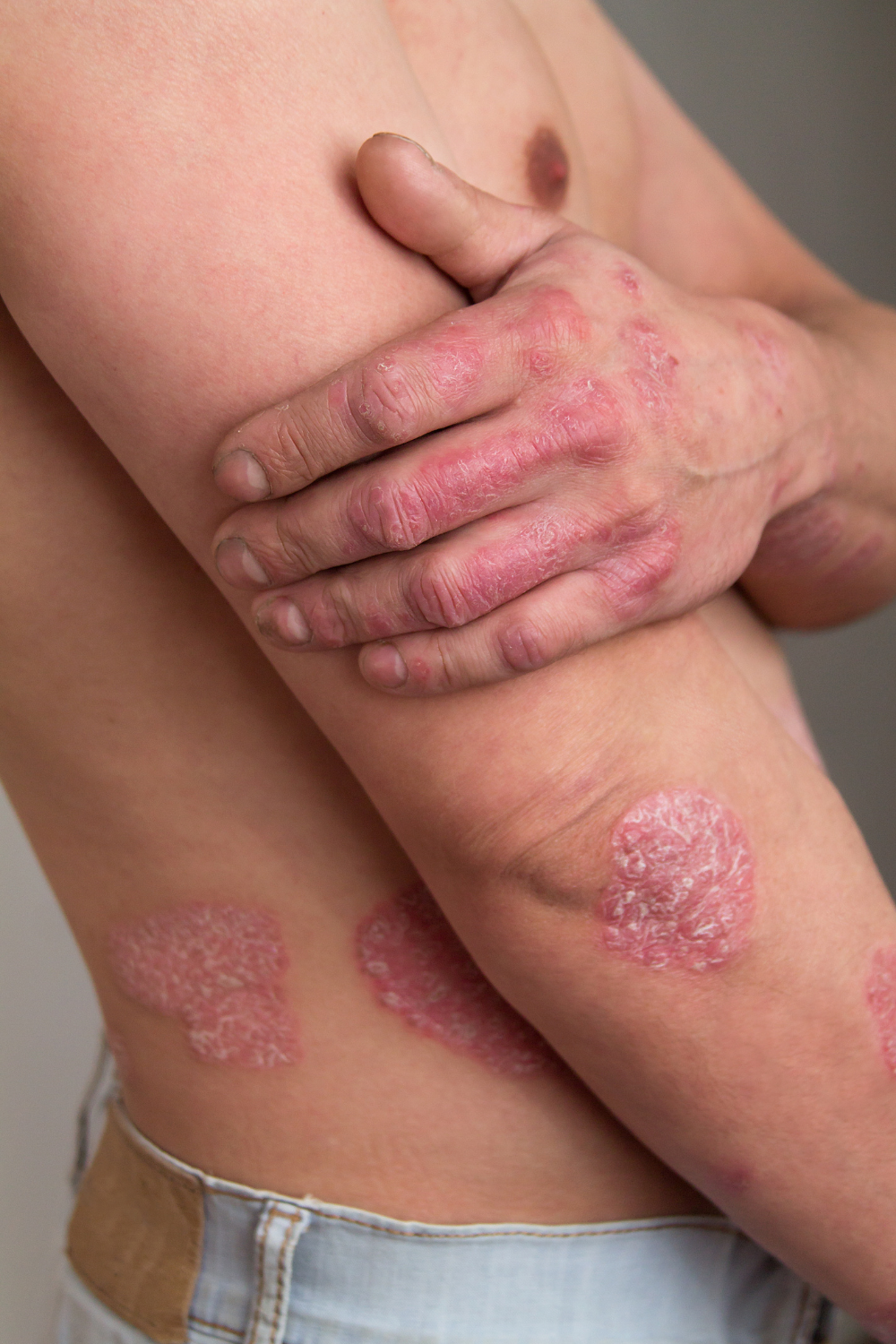 Home treatments for psoriasis; 5 effective remedies