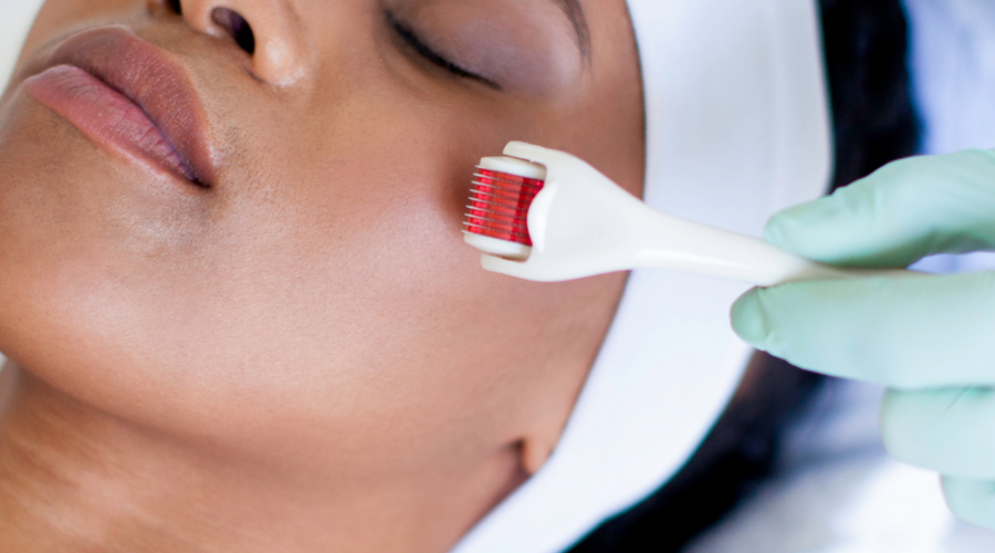 Microneedling Procedure, Benefits, and Other Aspects Explained