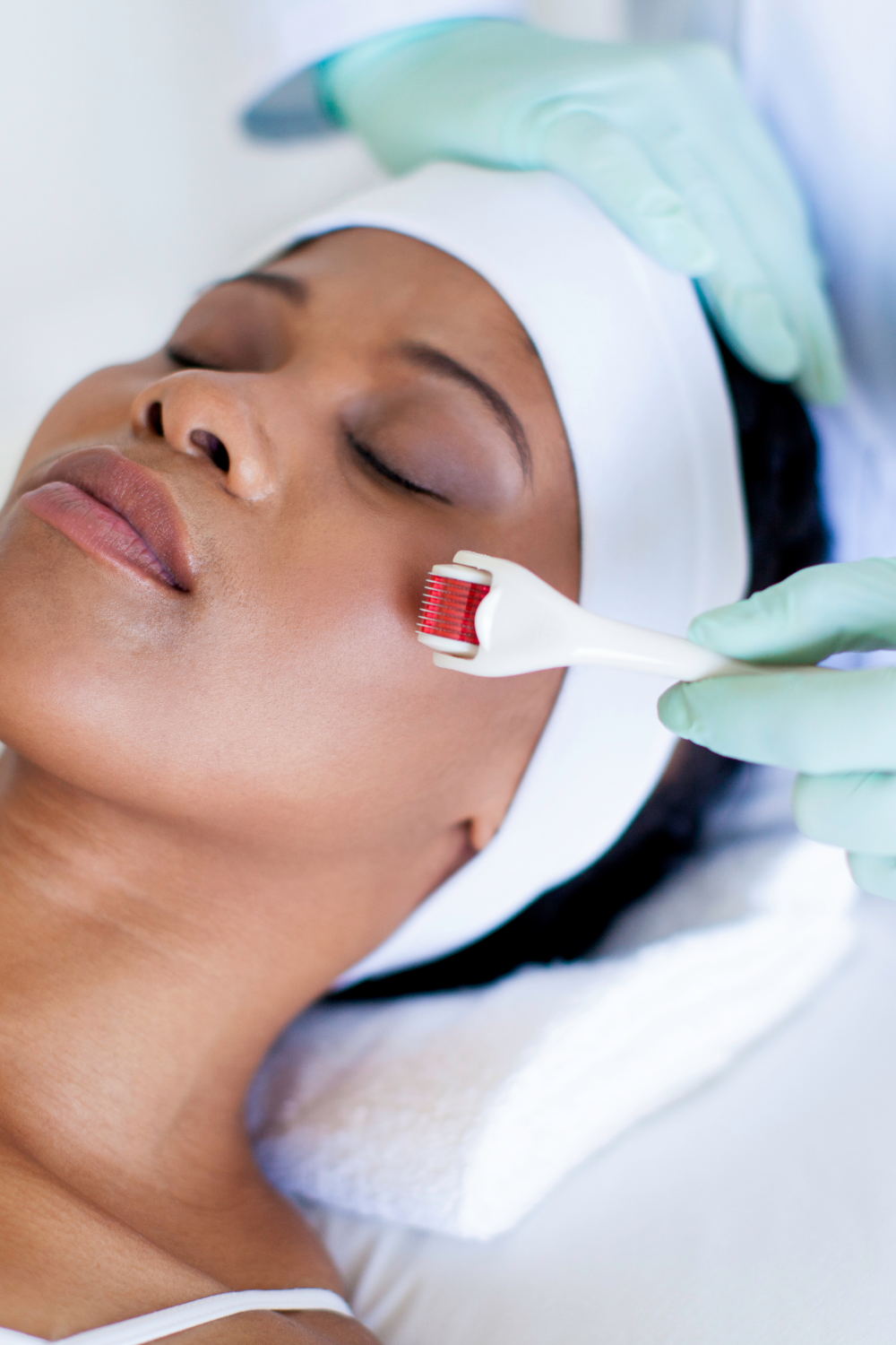 Microneedling Procedure, Benefits, and Other Aspects Explained