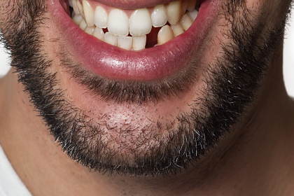 Understanding The Options When You Have Missing Teeth
