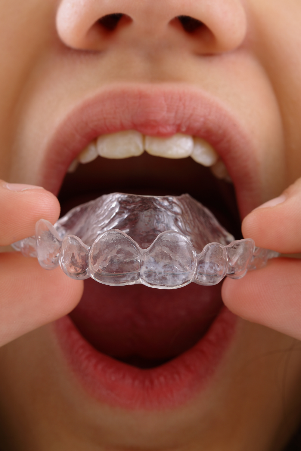 Here are 5 Fantastic Facts About Retainers