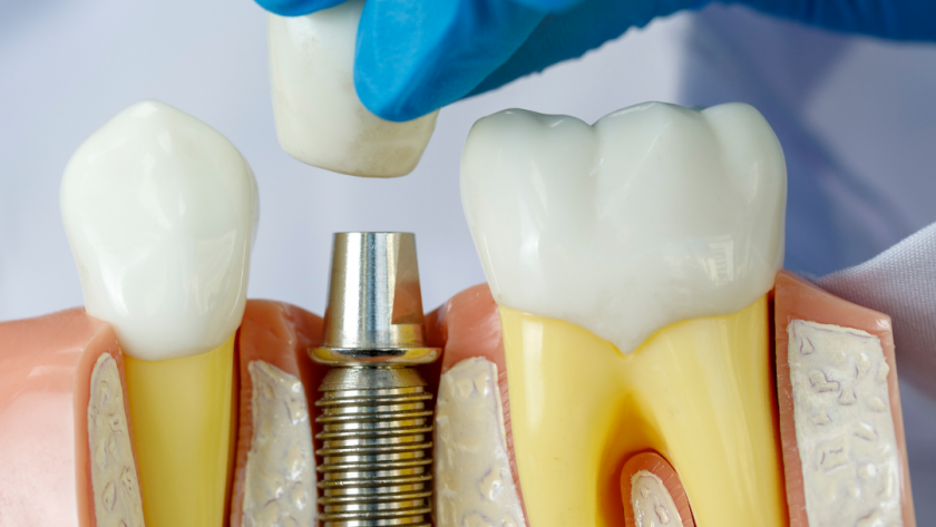 Top 5 Indicators You Need Dental Implants