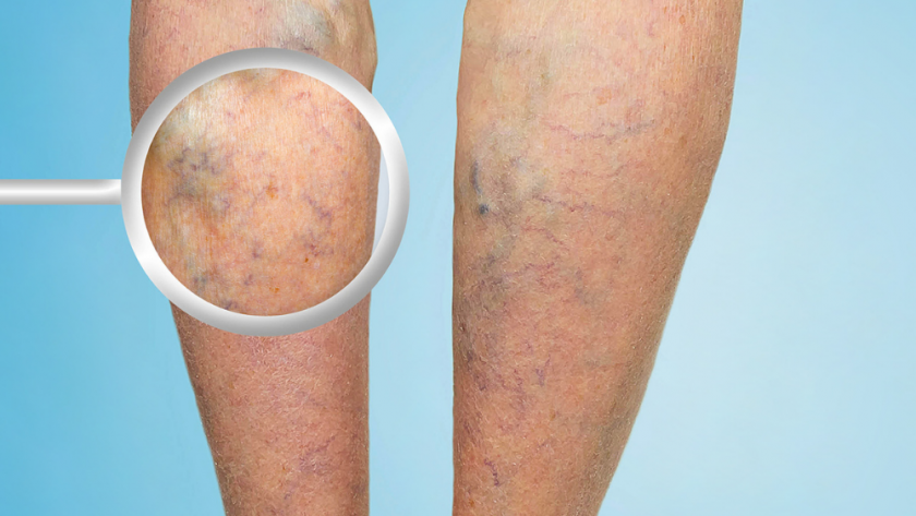 Varicose Veins: All You Need to Know