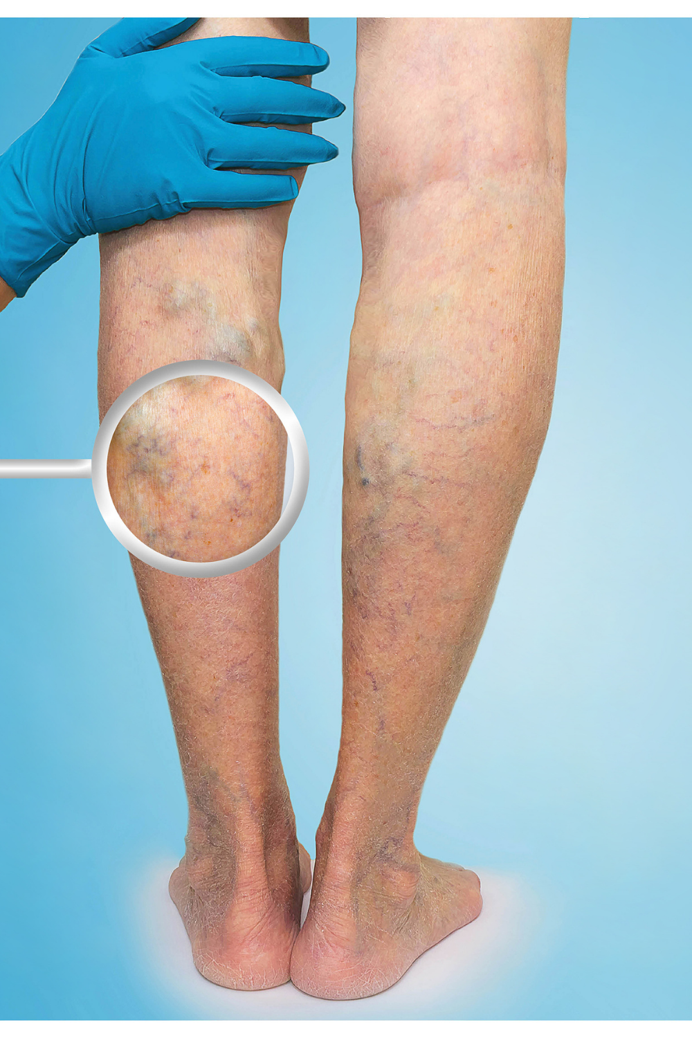 Varicose Veins: All You Need to Know