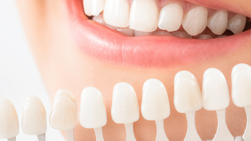 How Do Dental Crowns and Bridges Work?