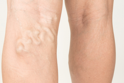 Leg Pain and Swelling Due to Varicose Veins: What Are The Treatment Options?