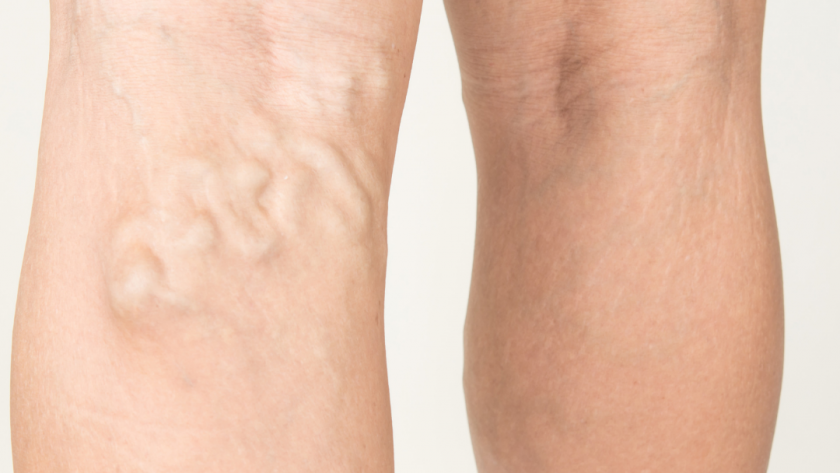 Leg Pain and Swelling Due to Varicose Veins: What Are The Treatment Options?