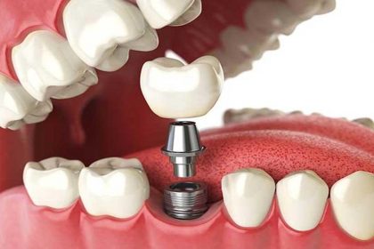 Are Dental Implants Worth It?