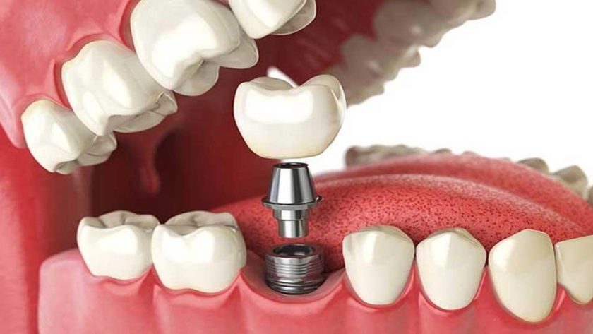 Are Dental Implants Worth It?