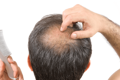 Dealing with Baldness: The Complete Guide To Treating Thinning Hair