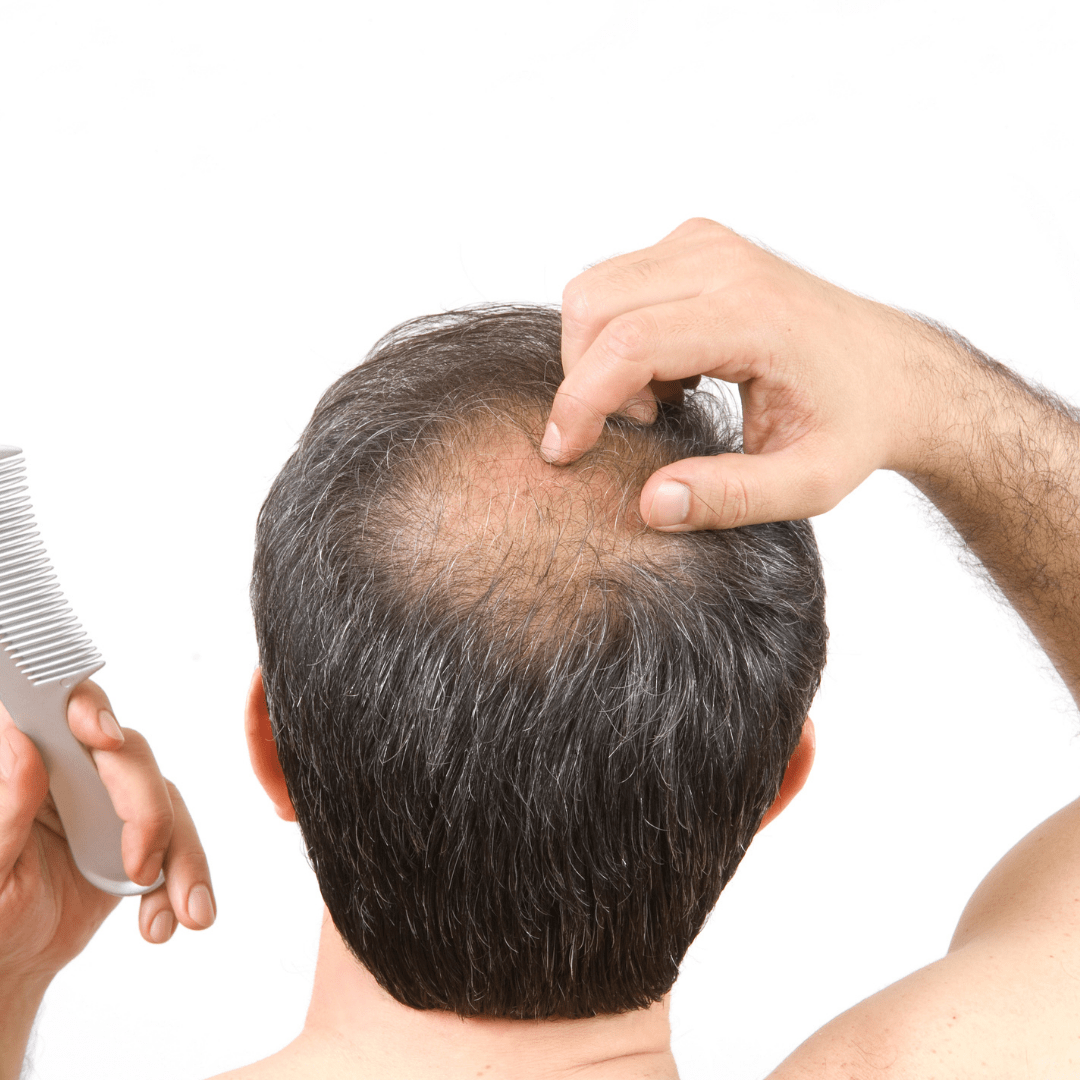 Dealing with Baldness: The Complete Guide To Treating Thinning Hair