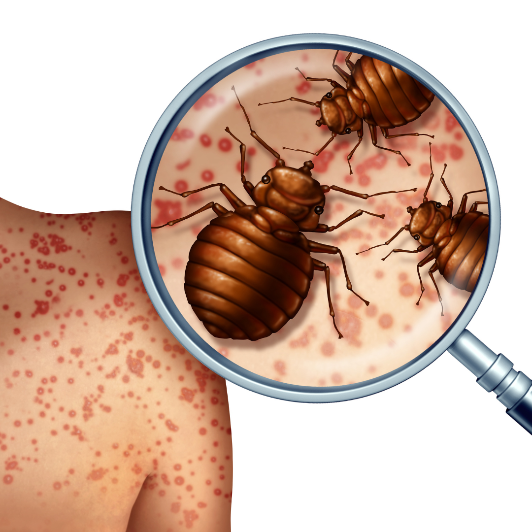 Differences Between Flea Bites and Bed Bugs