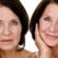 Significant benefits of mini facelift surgery