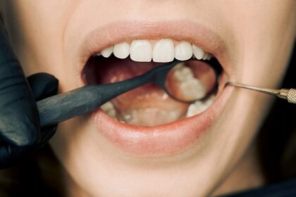 10 Foods to Avoid for Healthier Teeth and Gums