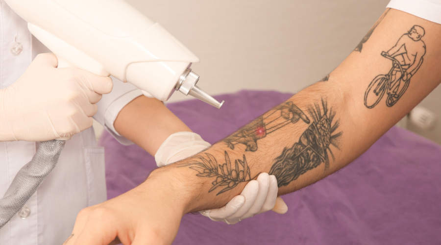 Considerations and Challenges for Tattoo Removal on Different Skin Types