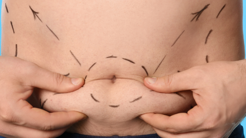 Confidence from Within: The Power of Abdominoplasty